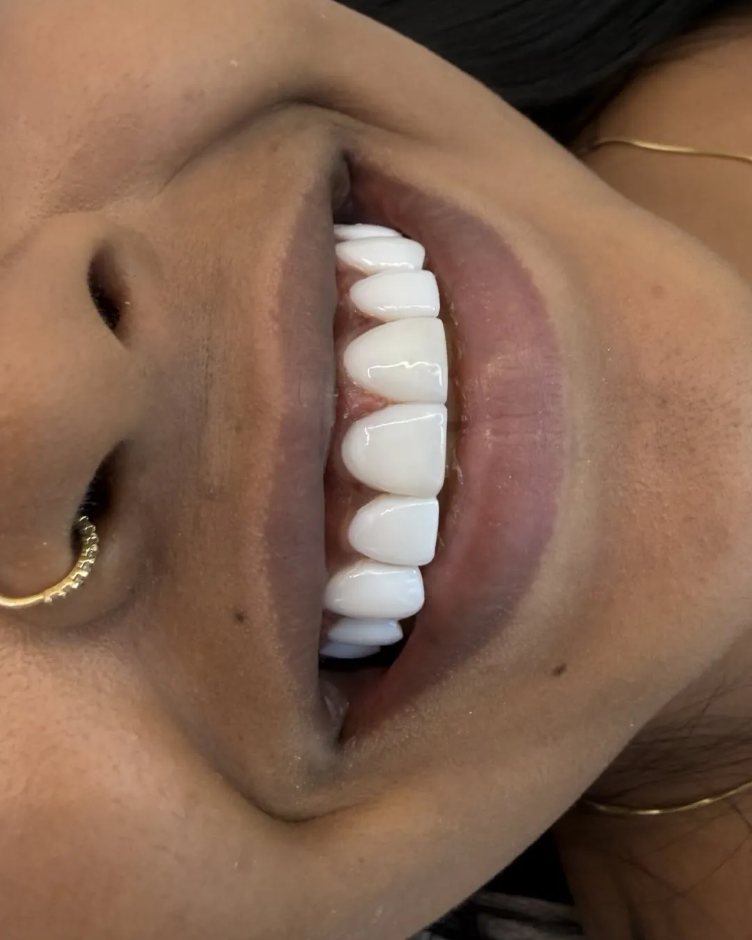 Resultado real de facetas de resina em paciente da Duomo Odonto Clinic — sorriso natural